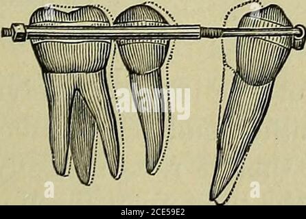 . Orthodontie, ou mauvaise position des dents humaines; sa prévention et son remède . Les appareils d'angle. Et sont conçus pour être soudés à des bandes. LL sont des leviers de piano-fil de différentes tailles, donnant différents degrés de puissance. Outre les avantages de la simiDlicité, de l'efficacité et de la propreté, qui sont assurés par ces ai3j)liances, un desideratum plus grand est obtenu par les principes de mécanique observés dans leur construction. L'an-chorage stationnaire et la non-abandon de la pression sont proéminentcaractéristiques de cette méthode, et sont certainement fixés presque toperfection, les moyens par lesquels on ou Banque D'Images