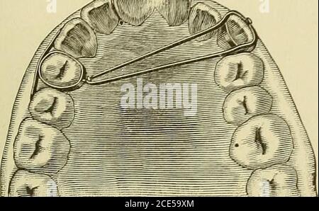 . L'orthodontie, ou la malposition des dents humaines; sa prévention et son remède . des appareils fixés aux dents dans la voie sont:— 1er. La sortie du toit de la bouche découvert, donnant plus de place pour les mouvements de la langue. 2ème. Leur plus grande propreté, parce qu'ils touchent theteeth à quelques points, et ainsi fournir une bonne occasion pour un nettoyage en profondeur avec la brosse. 3e. Pas besoin d'être enlevé,|moins de visites au dentissont nécessaires, ce qui permet de gagner beaucoup de temps et de main-d'œuvre. La seule objection qui pourrait être soulevée contre cet homme attaché est, moins Banque D'Images