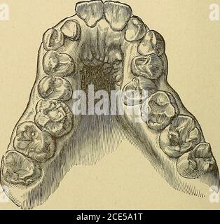 . Orthodontie, ou mauvaise position des dents humaines; sa prévention et remède . ssume acrowded et position irrégulière. Le fait que lorsque les bicuspides sont hors de la ligne ils arenEarly toujours trouvé pour être à l'intérieur de l'arche semble tofavor la supposition que l'irrégularité a été broughtabout de la manière suggérée. Une éruption précoce des cus-pids et une éruption tardive des bicuspides favoriseraient également la condition. 28 ORTHODONTIE. L'hypothèse selon laquelle les bicuspides une fois dans le hne peuvent en être expulses par la pression exercée dans l'éruption tlie de thesecond et de troisièmes molaires a le courage de le soutenir. Étaient possibles Banque D'Images