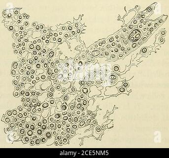 . Pathologie chirurgicale générale et thérapeutique, dans cinquante et un cours .. . T.tfiiue d'un sarcome dio, après Virchow. 350 diamètres agrandis. (p.) Le sarcome à cellules de la broche est composé de cellules de la broche allongées, usuallythin et étroitement emballées, appelées cellules du filament. Généralement il SARCOMATA. 647 Banque D'Images