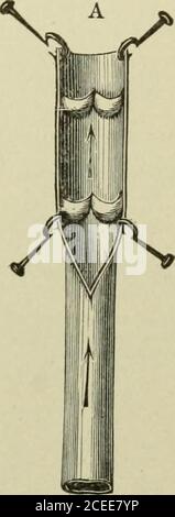 . Texte-livre d'anatomie et de physiologie pour les infirmières. Ils sont formés par l'Union des capillaires. Ils sont d'abord très petits (appelés venules ou radicules veineux) mais constantlycroissent plus grands en s'unissant les uns avec les autres, bien qu'ils se ramification et se réunirent souvent. Les veines, comme les artères, ont trois manteaux, mais leur pelage intermédiaire n'est ni si élastique ni si musculaire, de sorte qu'ils aresofter, Et lorsqu'ils sont vides ou coupés, ils s'effondrent.la couche intérieure des veines présente, à intervalles,des plis semi-uniens, faisant des poches appelées valves, qui permettent au sang de couler vers le coeur, mais l'empêcher de se mettre en arrière fr Banque D'Images