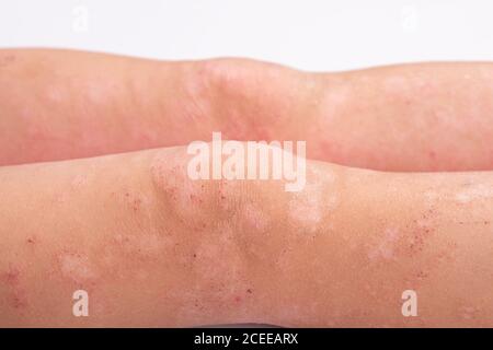 manifestation de la dermatite sur le corps de l'enfant, éruption cutanée sur les jambes en gros plan, rougeur sur la peau, réaction allergique. Banque D'Images
