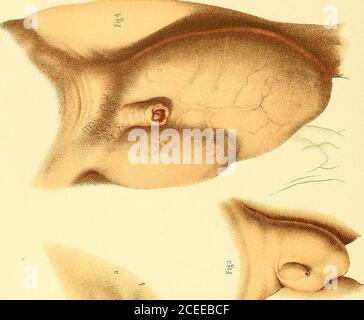 . L'anatomie et le traitement chirurgical de la hernie. Position courbée pendant quelques jours, les hanches plus haut que les épaules, et les parties soutenues, les applications chaudes localement, régime léger, opiacés, enemata, etc., souvent exigé. De cette façon, le soulagement est obtenu sans manipulation ou taxis, et quand ces mesures sont recourées à elles devraient être menées avec la grande diligence. La taille des hernies irréductibles est parfois énorme. Souvent, lorsque le patientis environ, la tumeur scrotale devient une difformité difficile à cacher. Birkett * rapportsThe: La plus grande double rupture que j'ai vu était dans un br Banque D'Images