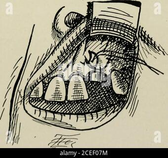 . Anesthésie orale; anesthésie locale dans la cavité buccale, technique et application pratique dans les différentes branches de la dentisterie. Figure 86. La racine de la dent est exposée. Figure 87. Après amputation de la racine et curetage de la cavité tlique. Figure 88. Couture de la plaie. 130 ANESTHÉSIE ORALE tous les côtés. Toutes les marges et les points aigus sont alors lissés avec une bavure ronde, et la cavité est soigneusement lavée avec une solution antiseptique douce. Cela est séché. Beprévision, stimuler la plaie avec un petit instrument, à inviteblesaignant pour la formation d'un caillot de sang. DRAM le flipper et le coudre à l'arrière Banque D'Images