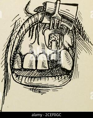 . Anesthésie orale; anesthésie locale dans la cavité buccale, technique et application pratique dans les différentes branches de la dentisterie. Figure 86. La racine de la dent est exposée. Figure 87. Après amputation de la racine et curetage de la cavité tlique. Banque D'Images