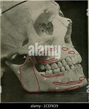 . Anesthésie orale; anesthésie locale dans la cavité buccale, technique et application pratique dans les différentes branches de la dentisterie. L'os maxillaire renferme une grande cavité, le sinus maxillaire max-maxillaire (O. T. Antrum de Highmore). Ses murs, par conséquent, sont très minces. Des quatre sur-faces, les processus antérieur et infra-temporal sont d'intérêt particulier tous, aussi les processus alviolaires, zygomatiques et palataux, et les processus infra-orbitaux, alviolaires postérieurs et palatine postérieurs fora-mina. a. La section antérieure s Banque D'Images