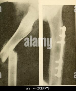 . Un nouveau manuel de chirurgie, civile et militaire. CHIRURGIE DES EXTRÉMITÉS 675. ir fracturé quatre semaines avant l'admission. Âge du patient sept ans. Même cas sept mois après l'application de jilatewa. 1 676 CHIRURGIE DES EXTRÉMITÉS FIXATION DES FRACTURES PAR GREFFE OSSEUSE à l'heure actuelle, de nombreux chirurgiens sont en voie d'abandonner l'utilisation de ma-térial étranger comme moyen de fixation pour les fractures et de remplacer la greffe d'autogène. Cela a l'avantage de ne pas placer un corps étranger dans les tissus. Dans la majorité des fractures Avhich exigent l'opération, la greffe d'abone peut être facilement introduit et wi Banque D'Images
