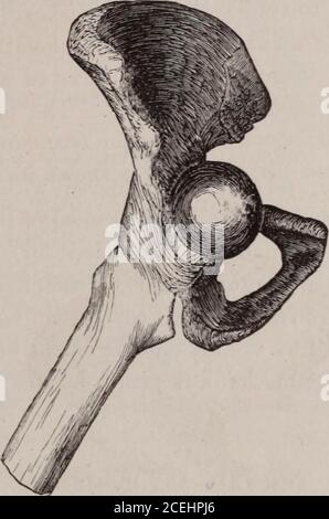 . Revue médicale et examinateur de Chicago. Figure 6—vue externe de la luxation pubienne, montrant la bordure postérieure du grand trochanter losé dans l'acétabulum, en appuyant avant la moitié postérieure de la capsule. 1884.] Gunn, réduction des dislocations. 463 ainsi pressée dans la cavité, cette partie postérieure de la Cap-sule est modérément tendue, mais elle exerce une influence importante sur la thisdislocation de quelque manière que ce soit. Au contraire, la portionilio-fémorale du ligament capsulaire en face ayant continuité de la structureavec la partie postérieure non déchirée de dessous le col de l'utérus, holdla tête dislogée Banque D'Images