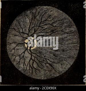. L'ophtalmoscope : son mode d'application expliqué, et sa valeur démontrée, dans l'exploration des maladies internes affectant l'œil. Hemiopy, avec rétine détachée. 132 L'OPHTALMOSCOPE. Figure 5.—œil gauche. L'amblyopie, exsudation sur la rétine, ressemble à celle du nerf optique; mais en plusieurs parties on peut voir des fracturations de pigment marron et noir; la marginde la grande tache apparaît d'un rouge brunâtre profond. Il y a aussi des stries rouge vif qui sont parallèles à une autre partie de la partie inférieure. L'ensemble du fond de l'oeil a un rouge brunâtre; les vaisseaux de la rétine aredistinc Banque D'Images