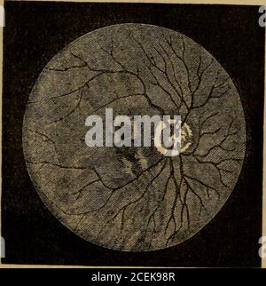 . L'ophtalmoscope : son mode d'application expliqué, et sa valeur montrée, dans l'exploration des maladies internes affectant l'oeil. Type. La vue de cet œil s'est récemment aggravée, de sorte que maintenant, en regardant directement, elle perd des objets immédiatement dans l'axe de la vision, L'OPHTALMOSCOPE. 131 et tout ce qui se trouve sur le côté extérieur, elle peut à peine se mouler suffisamment pour reconnaître. L'œil droit était en bonne santé au mois de novembre, puis elle a ressenti une légère prise de vue à travers elle, mais n'a pas découvert aucune diminution de la vue il y a trois jours (déc 19th), quand elle l'a trouvée si sombre shec Banque D'Images