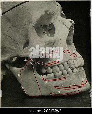 . Anesthésie orale; anesthésie locale dans la cavité buccale, technique et application pratique dans les différentes branches de la dentisterie. Avec une nervure, alors que la maxilla est de type irregulartype, contenant les principaux sinus de l'air du visage. L'os maxillaire renferme une grande cavité, le sinus maxillaire max-maxillaire (O. T. Antrum de Highmore). Ses murs, par conséquent, sont très minces. Des quatre sur-faces, les processus antérieur et infra-temporal sont d'intérêt particulier tous, aussi les processus alviolaires, zygomatiques et palataux, et les processus infra-orbitaux, alviolaires postérieurs et palatine postérieurs fora-mina. a. Antérieur Banque D'Images