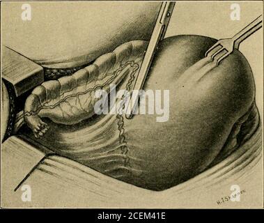 . Inflammation pelvienne chez les femmes. Figure 64.—montrant la circulation interovarienne. Figure 65.—conserver la circulation ovarienne en poussant l'utero-ovarianAnastomose dans les plis du ligament croisé. 167 168 INFLAMMATION PELVIENNE CHEZ LES FEMMES souffrant d'une infection chronique endocervicale et tubaire, il a été notre coutume de guérir la leucorrhée par l'excision radicale de la zone infectée dans le col de l'utérus, Et suivre cette procédure plastique par theablation des deux tubes, avec la résection du fond infecté de l'utérus, en utilisant une technique Bell-Beuttner modifiée. Cela laisse une quantité suffisante Banque D'Images