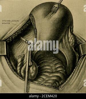 . Inflammation pelvienne chez les femmes. Figure 65.—conserver la circulation ovarienne en poussant l'utero-ovarianAnastomose dans les plis du ligament croisé. 167 168 INFLAMMATION PELVIENNE CHEZ LES FEMMES souffrant d'une infection chronique endocervicale et tubaire, il a été notre coutume de guérir la leucorrhée par l'excision radicale de la zone infectée dans le col de l'utérus, Et suivre cette procédure plastique par theablation des deux tubes, avec la résection du fond infecté de l'utérus, en utilisant une technique Bell-Beuttner modifiée. Cela laisse une quantité suffisante de corps utérin sain, avec son contenu muc Banque D'Images