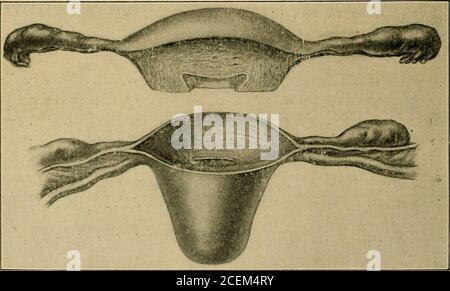 . Inflammation pelvienne chez les femmes. Figure 59.—libération du tube de son mésosalpinx en liguant les individuels Vessels et en n'interférant pas avec la circulation ovarienne. Figure 6o.—montrant l'étendue du filtre en coin excisé de fond et de corps. 164 Banque D'Images