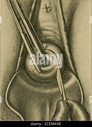 . Inflammation pelvienne chez les femmes. Figure 10.—la même procédure peut être utilisée dans les lacérations infectées. En place avec une garniture de gaze très étroite, ou en plaçant un point dans la sportio qui passe à travers les lèvres et l'anneau de la capsule (Fig.8). L'application est conservée dans le col pendant huit heures, puis déplacée à nouveau. En quelques semaines, l'érosion est guérie, la leukischecked, et la majeure partie du col de l'utérus réduite matériellement. Notre expérience, cependant, est trop limitée pour nous de tirer des conclusions définitives, excepto conseiller son essai ultérieur. Traitement opératoire.—Sturmdorf, dans son très excellent Banque D'Images