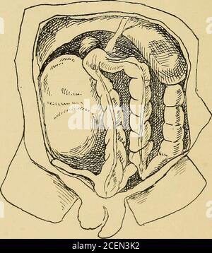 . Sur la hernie rétro-péritonéale : être les conférences 'Arris et Gale' sur 'l'anatomie et la chirurgie du fosse péritonéale' : livré au Collège royal des chirurgiens d'Angleterre en 1897. Figure 18. — hernie duodénale droite. Le sac est entouré par le côlon. t fosse. Q] négligé. Je propose d'appeler la poche la fosse de tAoOd^.Waldeyer. Cette fosse se trouve dans la concavité de l'archaforme par l'artère mésentérique supérieure; son orifice regarde vers la gauche, son fond vers la droite et vers le bas. Derrière vous se trouvent les vertèbres lombaires couvertes par le péritoine. Toute dent d'ouverture entrant dans cette pochette Banque D'Images