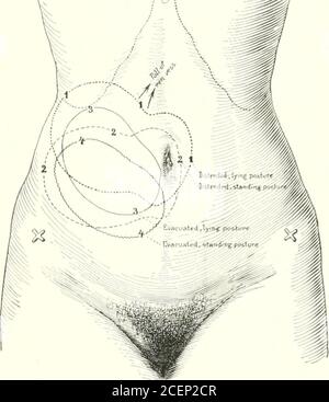 . Maladies des reins, des uretères et de la vessie, en particulier les maladies des femmes. Et Hnally le système tubu-lar du parenchyme, jusqu'au glomérule. Les dégénérativechanges progressifs wdiich se produisent dans le paren-chyma du rein sont montrés dans les theseries d'études faites par Max Broc-del et illustré à la figure 203. ITIS évident de cette série de studiesque le premier stade de la maladie est due à la pression de l'intérieur du pel-vis, qui aplatit la papillaryélévation, comprimant les canaux, et interférant ainsi avec la secre-tion urinaire. En raison de la proximité immédiate de la Banque D'Images