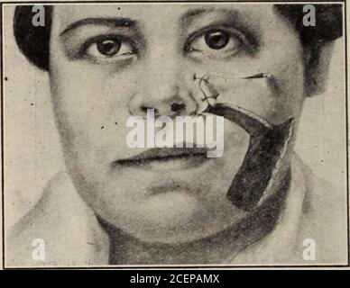 . Virginia Medical semestriel. Figure 11—Schéma de la section à retirer et à retirer de la joue à utiliser pour couvrir la défectine Fig. 10. deux sutures de matériau de la surface pour prendre la tension. Au moment où ils se détachent, la gesédede la plaie peut être suffisamment cicatrisée pour qu'elle puisse supporter la tension. Souvent, l'échec dans des opérations correctement formées résulte de conges-tion veineuses. Pour avoir des lambeaux bien nourris, il est tout aussi important d'évacuer le sang veineux que d'avoir accès au sang artériel. Figure 12—clapet relevé pour couvrir un défaut. Lorsqu’un volet a été coupé, l’écrour Banque D'Images