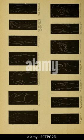 . Médecine moderne et revue bactériologique. Pré-sanctionné à la Fig. 2. Plaque 1, fig. 5, montre les contours d'une femme en bonne santé. Les Figures1-4 et 5-14 montrent les grandes lignes des femmes souffrant de diverses formes de déplacement viscérale. Relation des proportions du prolapsus viscéral de Trunkto.— depuis quelques années, Ihas fait des études anthropométriques prudentes de tous mes patients, faisant des mesuresselon les règles généralement suivédans des observations de ce type. J'ai ex-tendance mon étude aux femmes paysannes de diverses nationalités, en particulier les femmes françaises, allemandes, italiennes et chinoises, une seule tribu d'Indi oriental Banque D'Images