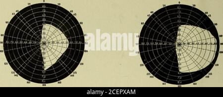 . Médecine moderne et revue bactériologique. ChemUl et diplômé de l'Ecole Centrale des Arts fabrique de Paris (France). VENDU PAR LES PRINCIPAUX DROGGISTES. ^&ni!£h^^ Laboratoire, 28 Prince St., New York. Figure /.— champ de vision de l'œil gauche. Figure 2 — champ de vision de l'œil droit. Aperçu du champ de vision dans le cas 2. — Hemianopsia Homonomous gauche. Banque D'Images