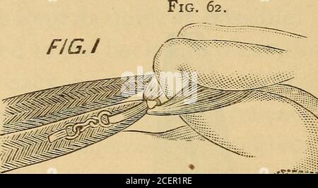 . Soins infirmiers en chirurgie abdominale et maladies des femmes. Support de jambe. Cette position doit être bien tirée du dessous des hanches et poussée au-dessus du coussin de fonctionnement, qui est ensuite placé sous elle. Les membres, pliés, peuvent être fixés en position par le porte-jambe, comme le porte-jambe illustré dans la coupe, ou maintenus par des assistants. La jambe - 228 MALADIES DES FEMMES. Support, étant projeté autour du cou du patient, attaché, juste au-dessus du genou, à chaque membre. Une feuille doit être drapée de façon à ce que la personne tocover les membres et à protéger le patient aussi loin que possible d'une exposition inutile. Certains opérateursutilisent un b lâche Banque D'Images