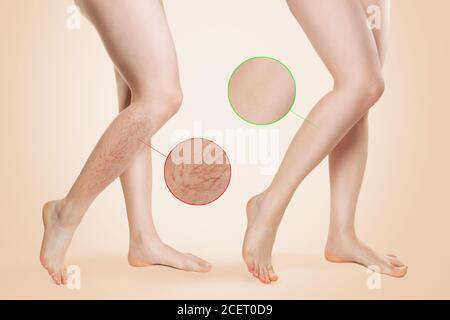 Une femme aux jambes douces et belles, aux varices sur la jambe inférieure. Image agrandie des varices. Avant et après le concept. Fond beige Banque D'Images