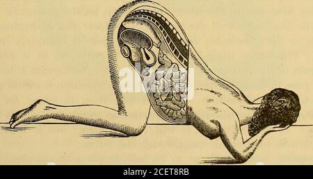 . Un système de médecine, basé sur la loi de l'homéopathie. Dessiné et réappliqué. Lorsqu'il est habilement utilisé, l'utérus est inerringlyrestauré à sa position correcte, à moins qu'il ne soit lié par des adhe-sions cicatriales. Comme la personne du patient n'est pas exposée pendant l'opération, il est moins répréhensible que tout autre, ainsi que moins douloureux. L'utérus peut être parfaitement remis en place, en raison de sa douceur, ou du laxcondition de ses supports naturels, il peut s'enfoncer dans son vieux placesauf si un grand soin est utilisé. Dans certains cas, le repositionnement doit être effectué sur la fig. 10.. être effectués plusieurs fois avant l'uteru Banque D'Images