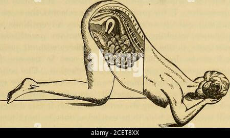 . Un système de médecine, basé sur la loi de l'homéopathie. Position genou-coude. Les figures qui l'accompagnent illustrent le principe. Figure 9 montre l'utérus rétroverté. Il est évident que le poids de l'organe aura tendance à lancer le fond vers l'avant. La Fig.10 représente l'utérus restauré à son angle normal. Comme il est desir-capable que la femme devrait garder une position allongée pour un jour ou deux, au moins, après l'opération, ceci est mieux effectué sur le lit, le patient étant placé commodément près de son bord. La boule de l'instrument, recouverte d'un généreux revêtement de vaseline, est passée doucement Banque D'Images