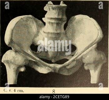 . Un livre de texte américain d'obstétrique. Pour les praticiens et les étudiants. F L -*f -v ^W K**i C. v. o± cm.Effec.tr. diam. 11 cm. Pelvis à contrat transverse (Robert; modèle au Mutter Museum, Collège des médecins, Philadelphie).2. Pelvis à contraction transverse, montrant une contraction à la noix (modèle dans la Collection Hirst, I niversity of Pennsylvania). 3. Pelvis contractées de façon transverse, sans sacrum (Hohl). 4. Split pelvis (Schauta).5. Pelvis rachitique généralement à contrat égal (Collection Hirst, Université de Pennsylvanie). 6. Pelvis rachitique généralement contractée (Hirst Collectio Banque D'Images