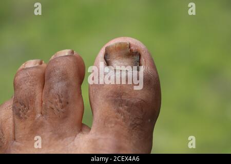 Ulcères du pied, figure dehors de l'ongle, champignon de la Toenail au pic de l'infection, Onychocryptose sur fond vert Banque D'Images