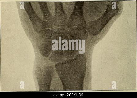. Un traité pratique sur les fractures et les dislocations. Figure 1.—ancienne dislocation vers l'arrière de l'OS Magnum,. Figure 2.—identique à la Fig. 1. DISLOCATIONS DES OS CARPIENS. 697 en deux (Erichsen, Fergusson) par un effort musculaire; en un (Grae l) par la pression de la main sur un fer à repasser tout en reportant les vêtements. Dans le cas d'Erich-sens, le bono a été dressé le bras sur une distance de près d'un pouce. Sans doute le déplacement était le; résultat de la rupture ou de thetendon sous l'os. OS Magnum. De nombreux auteurs parlent de la dislocation partielle de la tête de l'os manum vers l'arrière comme un accident non rare produit par prolongé Banque D'Images