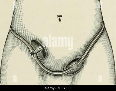 . Hernie abdominale : son diagnostic et son traitement. Caoutchouc dur 4, courroie de laparotomie, avec caoutchouc dur ou compresse souple. 5. Structure de capot Modifié pour la hernie ventrale du côté droit et pour la hernie inguinale du côté gauche. Banque D'Images