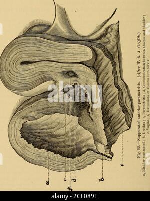 . Maladies des femmes. Un guide clinique de leur diagnostic et de leur traitement. glas conteneug sérum Fold of cervicalcaual VeinSymphysis pubis. Urètre tissu cellulaire eVagina anus (partie supérieure) Fig. 94.—Section à travers le bassin de la femme puerpérale dans le plan sagittal, le tissu showingcellulaire entre l'utérus et la vessie. {après Barbour.) —dans certains cas de paramètrite puerpérale, l'inflammation ne monte pas au-dessus du bord pelvien, mais s'étend dans le samemanner comme dans la forme non puerpérale, vers le bas jusqu'à la sortie pelvienne et vers l'arrière autour du rectum. Les Thesecases ressemblent à une paramétite non puerpérale dans leur cour Banque D'Images