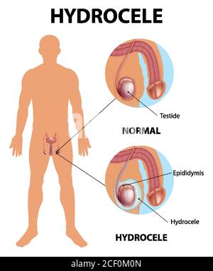 Affiche médicale montrant différents entre le testicule normal mâle et l'hydrocèle illustration Illustration de Vecteur