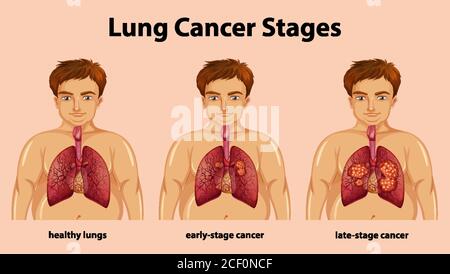 Illustration informative des stades du cancer du poumon Illustration de Vecteur