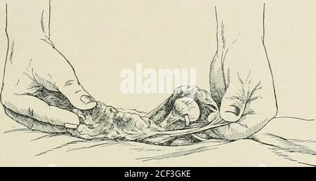 . Hernie abdominale : son diagnostic et son traitement. Emplaquée le soulagement des cas de testicules retardés, mais l'apparition de hernie inguinale ordinaire.* Fig. 129. Sac avec testicule à l'intérieur, indiqué par une ligne en pointillés. L'emplacement du cordon n'est pas si distinct qu'indiqué ici. Juste combien j'ai pu avoir été influencé par cet article, ou si je l'avais même lu, est maintenant impossible pour moi tosay, mais de ceci je suis tout à fait sûr que je ne l'ai pas eu à l'esprit au moment où l'opération a été exécutée. La procédure est la suivante: L'incision est faite à tous les égards comme dans la Bassiniopération, l'aponeurosis de la Banque D'Images