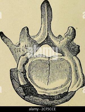 . Un traité pratique sur les fractures et les dislocations. Fracture avec compression des troisième et quatrième vertèbres lombaires. Ou en dessous. Le disque intervertébral peut être partiellement comprimé, ce qui porte avec lui une échelle osseuse de l'une ou l'autre des vertèbres ou des deux. La fracture des arches vertébrales, selon Gurlt, est trouvée dans l'abouthalf les cas de fracture des vertèbres cervicales, et seulement dans un - FRACTUUEH DE LA VFllTEBRM. I 15 septième de ceux de la dorsale, et un huitième de ceux de la lombaire.1HE attribue la fréquence de cette forme de fracture dans la cervicalpine à la b comparativement plus grande Banque D'Images