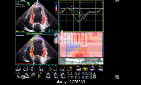 Image du cœur en mode échelle de gris pendant l'échographie transœsophagienne. Banque D'Images