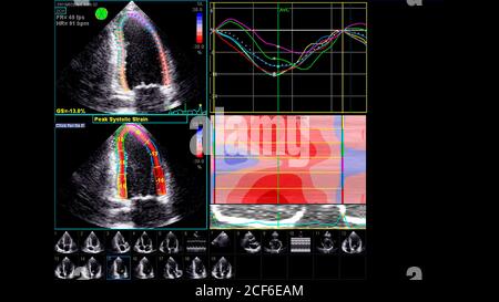 Image du cœur en mode échelle de gris pendant l'échographie transœsophagienne. Banque D'Images