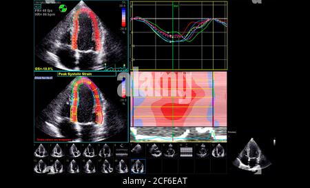 Image du cœur en mode échelle de gris pendant l'échographie transœsophagienne. Banque D'Images