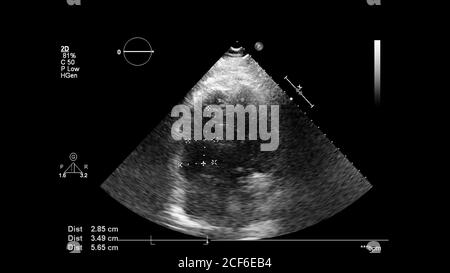 Image du cœur en mode échelle de gris pendant l'échographie transœsophagienne. Banque D'Images
