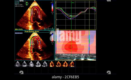 Image du cœur en mode échelle de gris pendant l'échographie transœsophagienne. Banque D'Images
