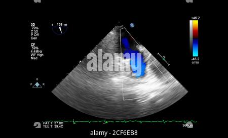 Image du cœur pendant l'échographie transœsophagienne avec mode Doppler. Banque D'Images