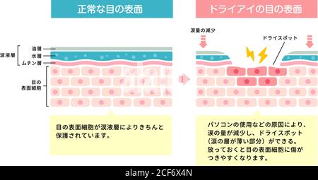 Illustration de comparaison entre l'œil normal et l'œil sec. Coupe transversale de la surface de l'œil. (Japonais) Illustration de Vecteur