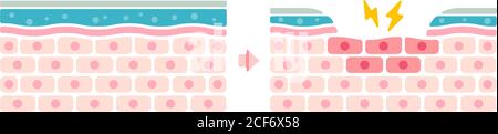 Illustration de comparaison entre l'œil normal et l'œil sec. Coupe transversale de la surface de l'œil. (pas de texte) Illustration de Vecteur