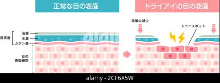 Illustration de comparaison entre l'œil normal et l'œil sec. Coupe transversale de la surface de l'œil. (Japonais) Illustration de Vecteur