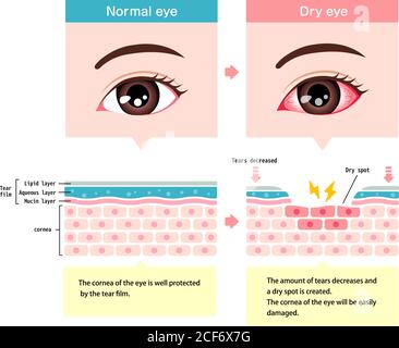 Illustration de comparaison entre l'œil normal et l'œil sec. Coupe transversale de la surface de l'œil. Illustration de Vecteur