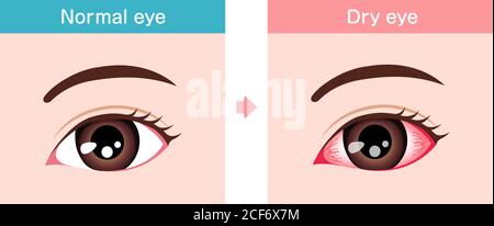 Illustration de comparaison entre l'œil normal et l'œil sec. Illustration de Vecteur