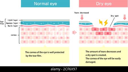 Illustration de comparaison entre l'œil normal et l'œil sec. Coupe transversale de la surface de l'œil. Illustration de Vecteur
