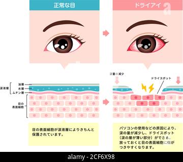 Illustration de comparaison entre l'œil normal et l'œil sec. Coupe transversale de la surface de l'œil. (Japonais) Illustration de Vecteur